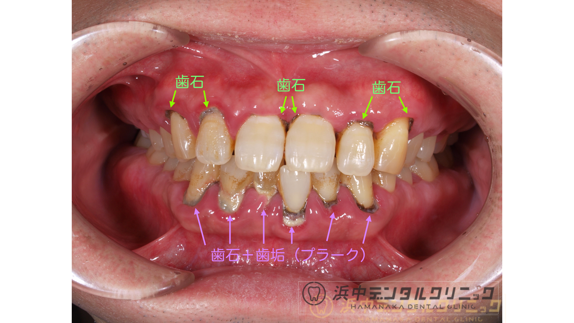 歯周病 浜中デンタルクリニック