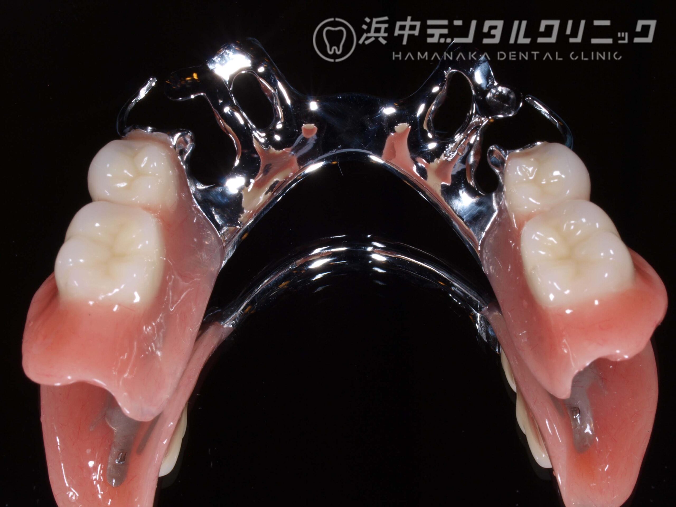 レンジ床義歯
